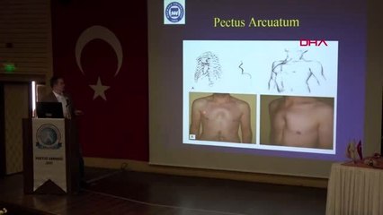 İzmir bilimsel toplantıda canlı 'çökük göğüs' ameliyatı yapıldı
