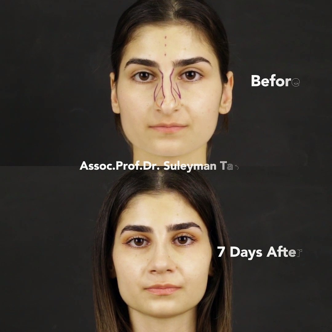 Closed Rhinoplasty for Female Patient - Dailymotion Video