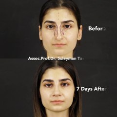 Closed Rhinoplasty for Female Patient