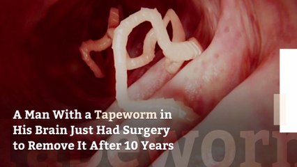 A Man With a Tapeworm in His Brain Just Had Surgery to Remove It After 10 Years
