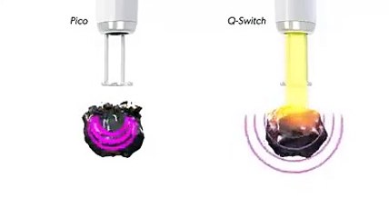 The Most Powerful Pico in the Country Arrives At Renude Laser