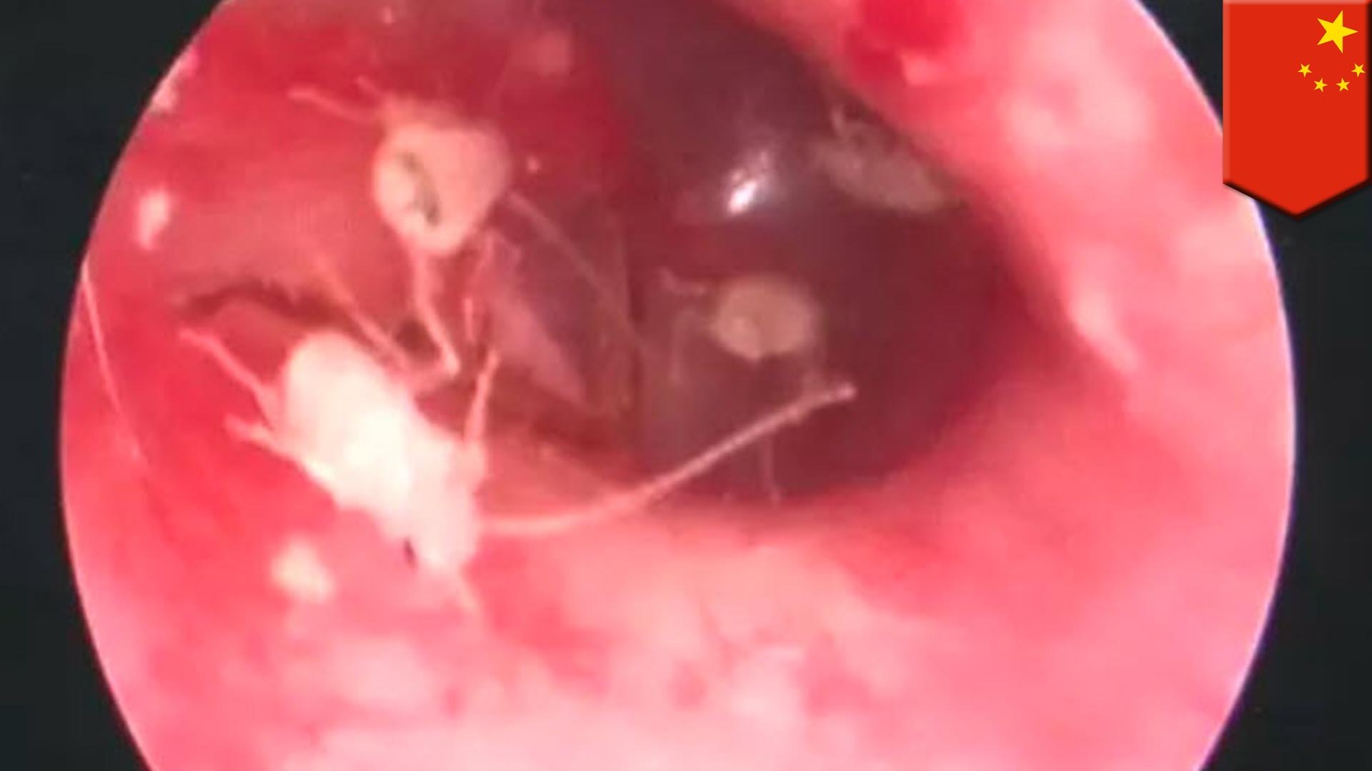 グロ 耳の中の激痛で目が覚めた男性 正体はゴキブリの大群 トモニュース 動画 Dailymotion