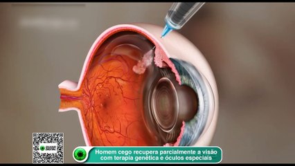 Homem cego recupera parcialmente a visão com terapia genética e óculos especiais