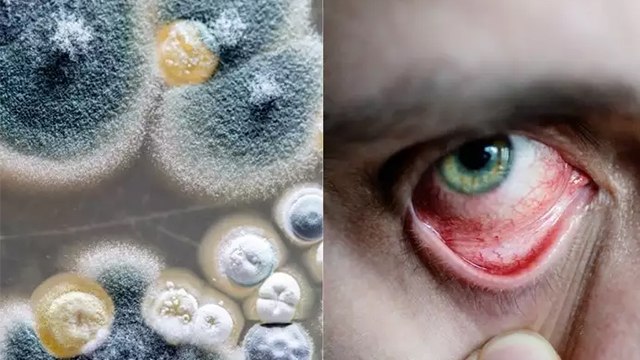 Covid-19 औऱ Black Fungus एक साथ हो सकता है । जानिए क्या कहते है Experts । Boldsky