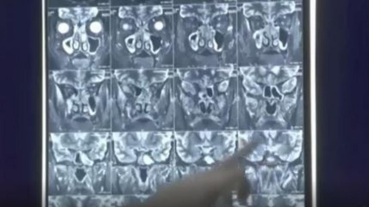 Experts view on alarming rise of Black Fungus cases