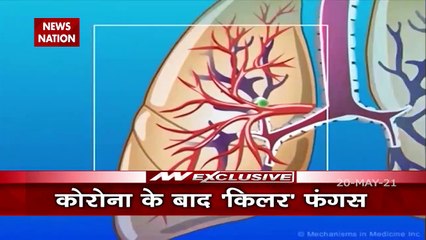 Delhi HC ने दिए केंद्र को Black Fungus की दवाएं आयात करने के आदेश