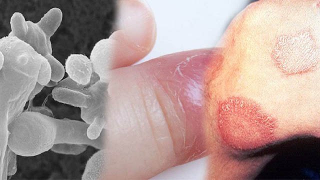 White Fungus Body के इन Parts को करता है Effect | know which organs are affected white fungus