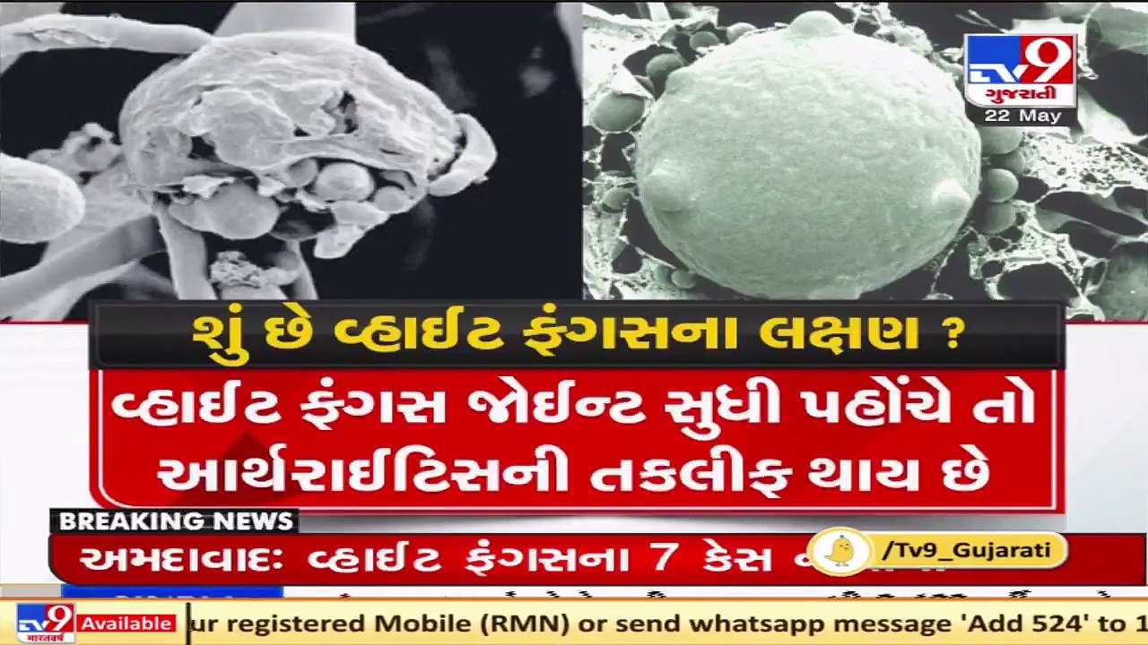 Coronavirus_ White fungus cases on rise; Signs, symptoms and who is at risk _ TV9