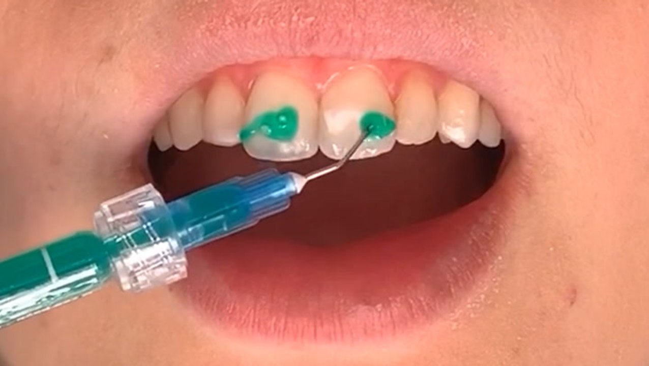 How white spots on teeth are removed