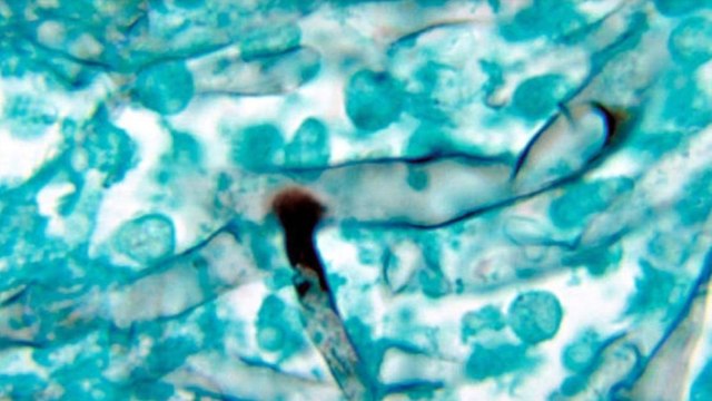 Is white fungus more dangerous than black fungus?