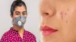 N95 Mask पहनने से निकल रहे हैं Pimples, तो ये उपाय कर सकते हैं आपकी मदद । Boldsky