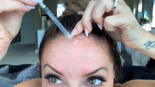 Bunny Injections Before And After #Botox #Forehead #Crowsfeet #Lipflip