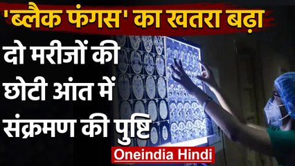 Small Intestine में Black Fungus, Ganga Ram Hospital के डॉक्टर ने कहा दुर्लभ मामला | वनइंडिया हिंदी