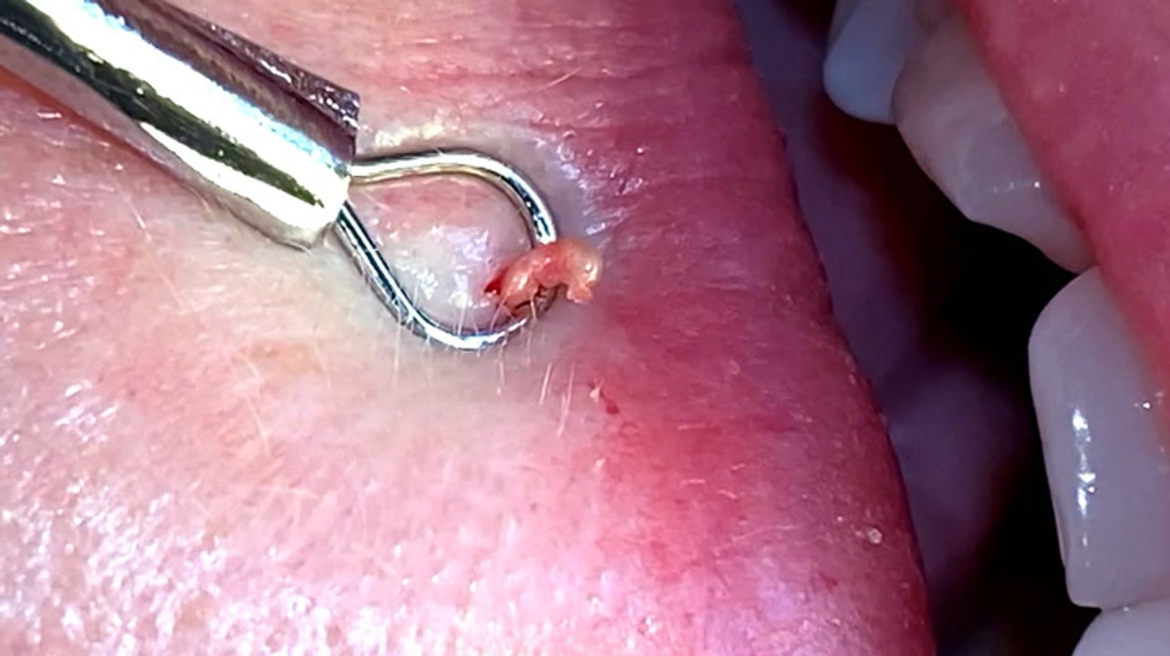 How milia are satisfyingly extracted by professionals