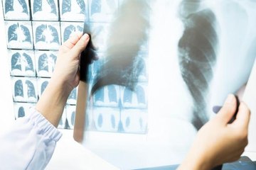 AMERİKAN KANSER DERNEĞİ AÇIKLADI; AKCİĞER KANSERİNDE TARAMA YAŞI DÜŞTÜ