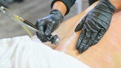 A body dermalinfusion treatment can improve skin texture and acne