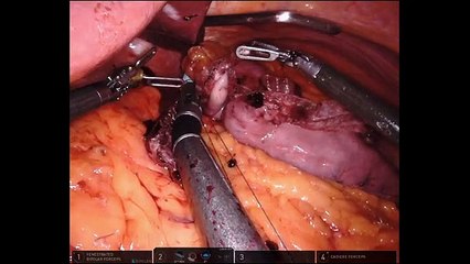 Completely Robotic Biliopancreatic Diversion with Duodenal Switch