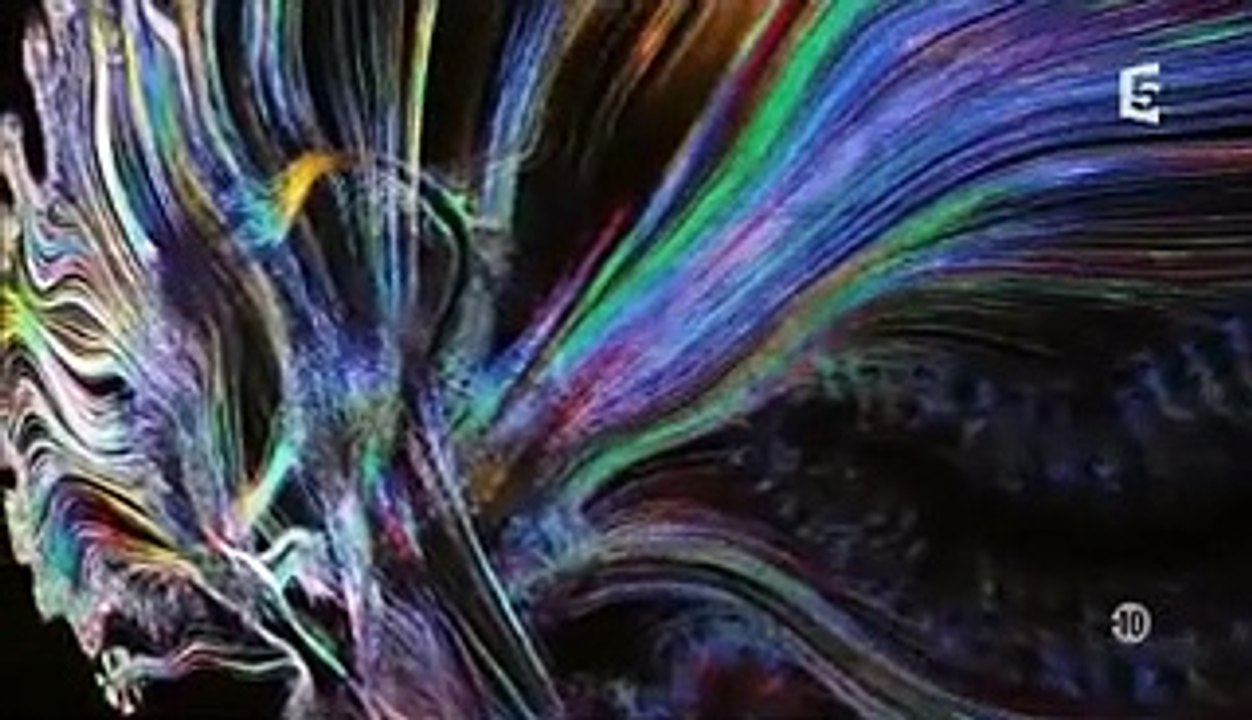 Amnésie Traumatique et IRM cérébrale