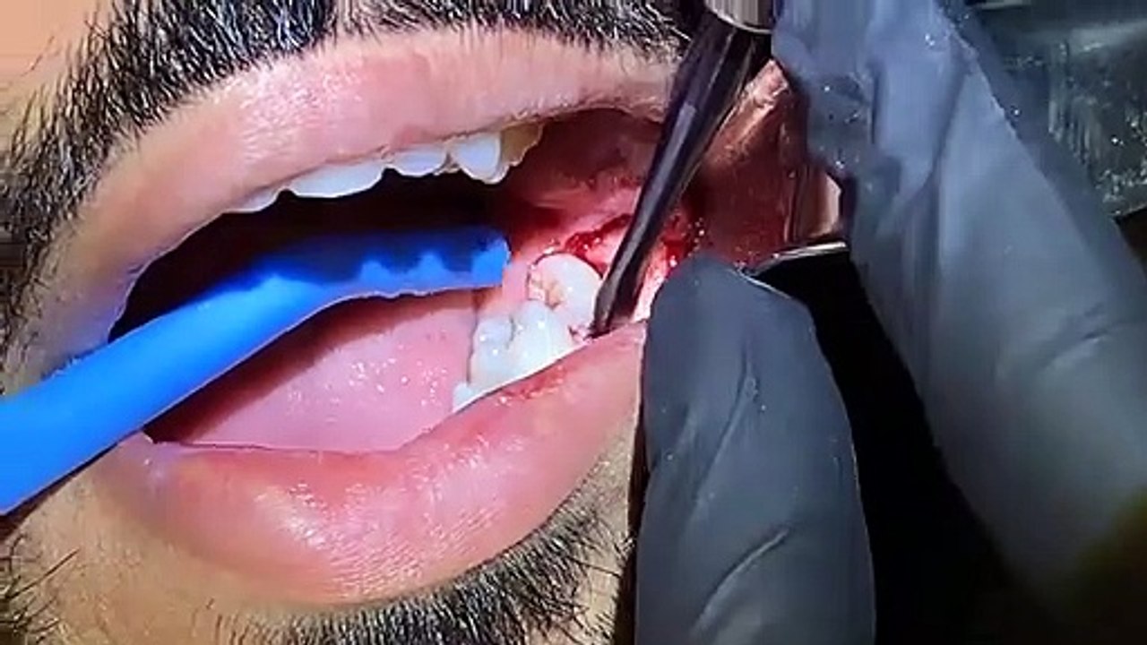 Wisdom Tooth Extraction Surgery Procedure