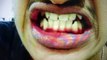 ADULT BRACES TREATMENT ,CROOKED ,OVERJET, OVERBITE ,BRACES BEFORE AFTER