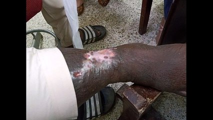 Leg Ulcers Profile: Short video