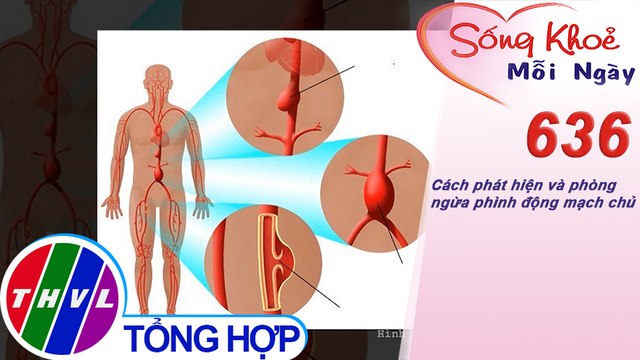 Cách phát hiện và phòng ngừa phình động mạch chủ | Sống khỏe mỗi ngày - Kỳ 636