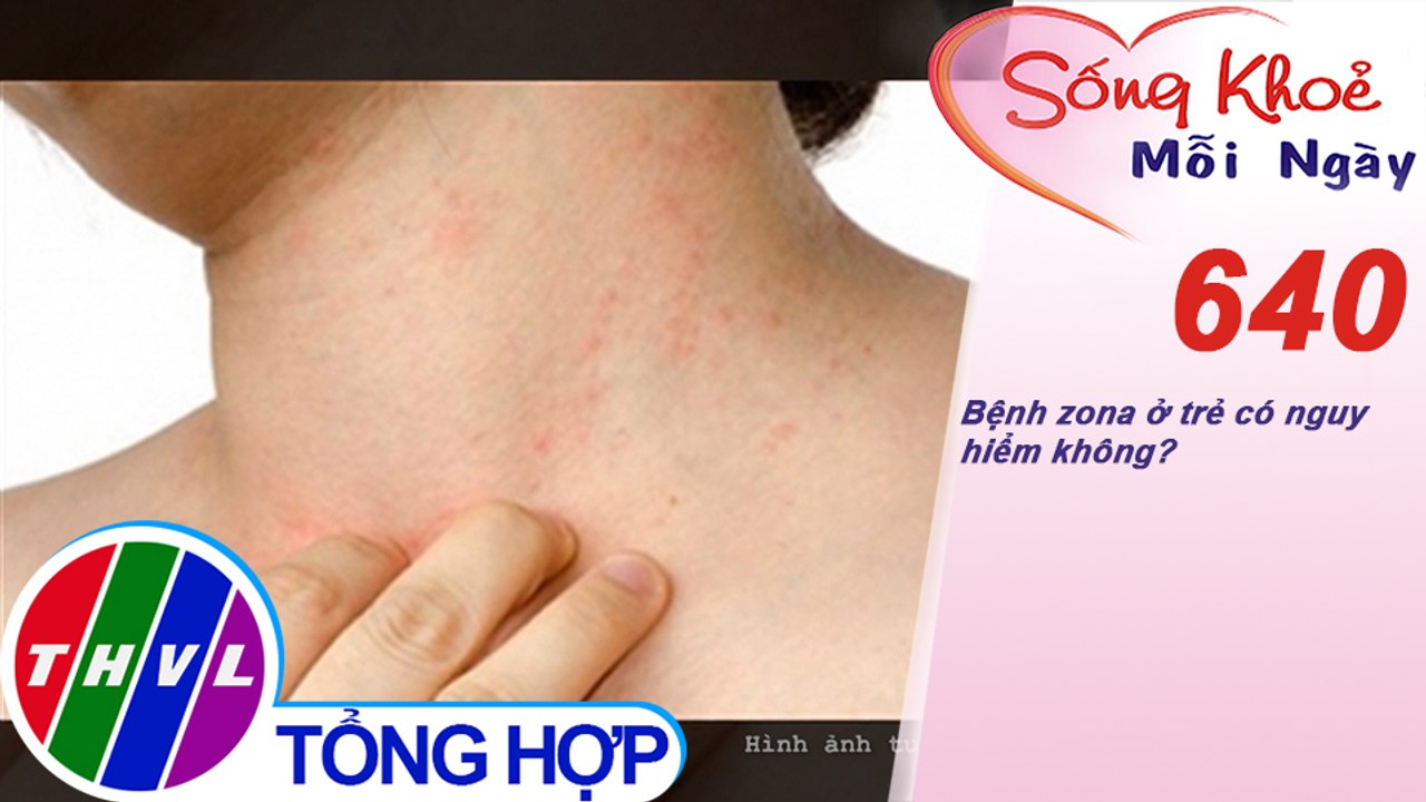 Bệnh zona ở trẻ có nguy hiểm không? | Sống khỏe mỗi ngày - Kỳ 640