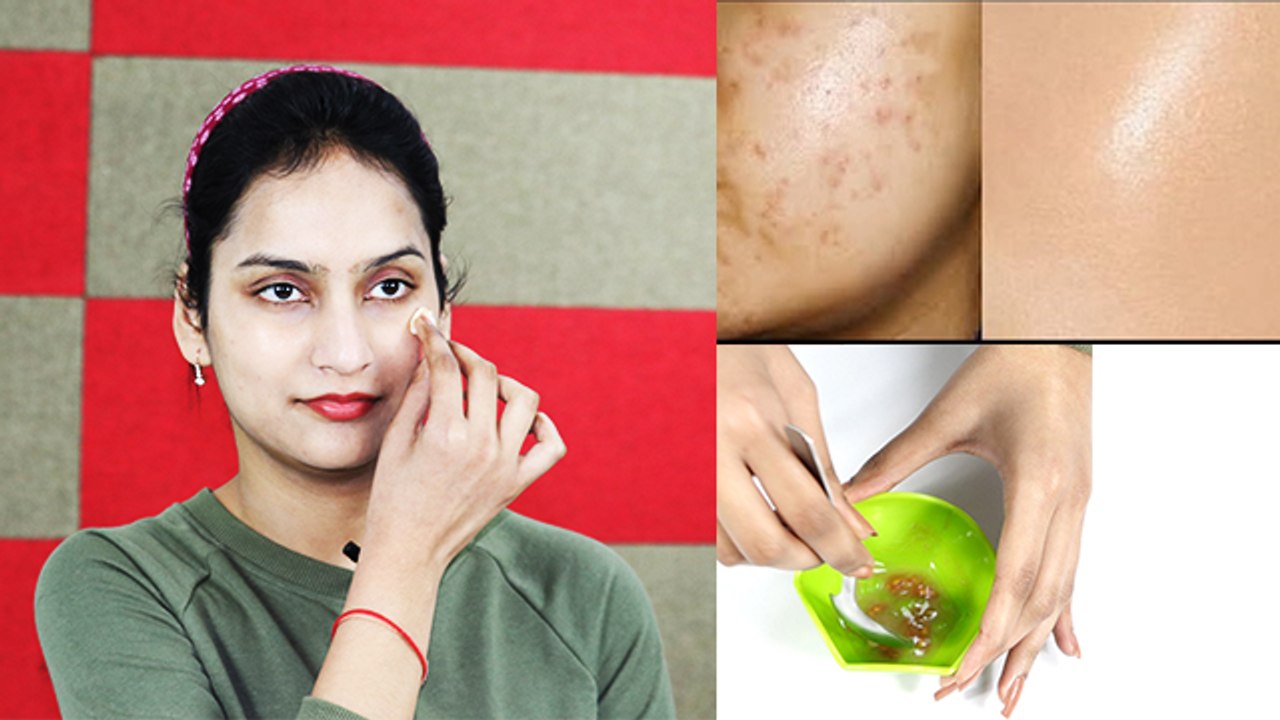 एक ही रात में Pimples के निशान हो जाएंगे गायब D...