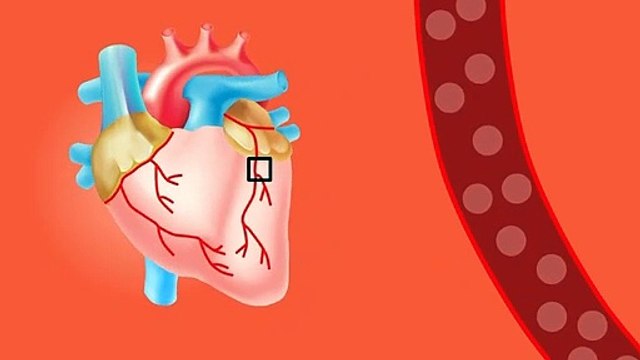 Heart Attack: Early Signs and Symptoms - What is a heart attack Hindi Urdu | What Causes a Heart Attack?