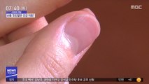 [스마트 리빙] 손톱 '조반월' 없는데 건강 괜찮을까?