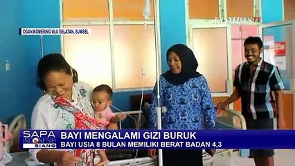 Gizi Buruk pada Anak 8 Bulan