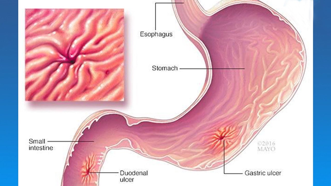 bd-úlceras-perforadas-180220