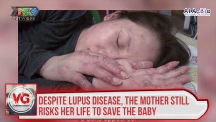Despite Lupus disease, the mother still risks her life to save the baby