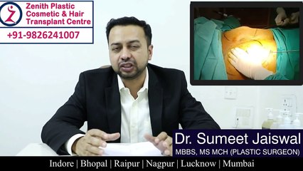Gynaecomastia Surgery in indore by dr sumeet jaiswal