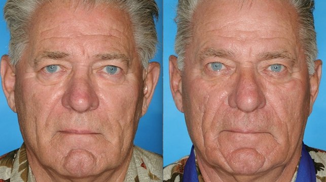 Des fumeurs photographiés aux côtés de leur jumeau non fumeur