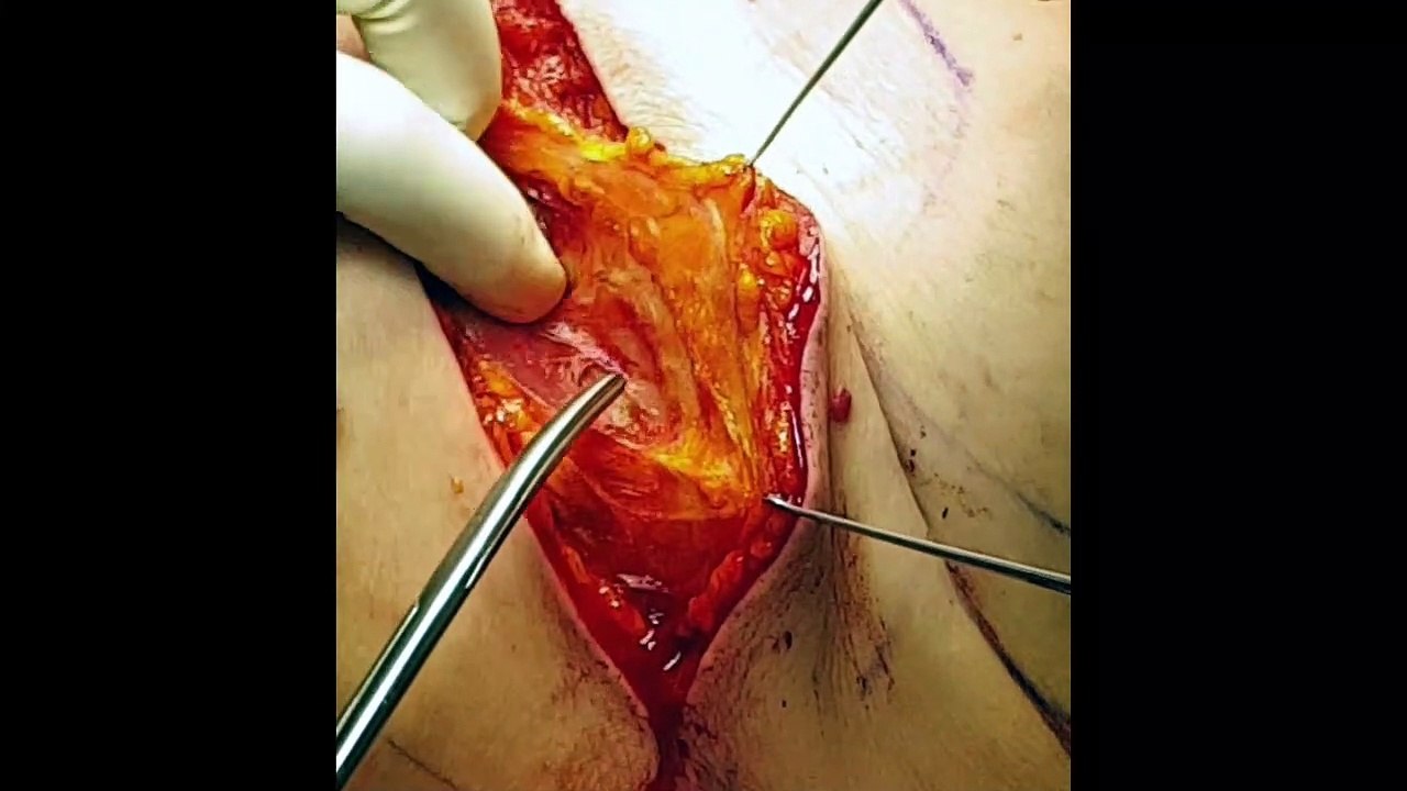 DPC par laparoscopie avec résection vasculaire