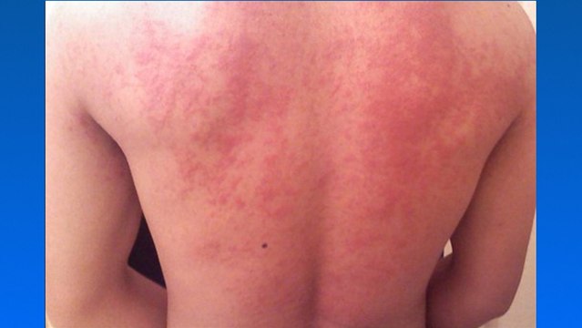 bd-causas-y-tratamientos-dermatitis-cronica-210220