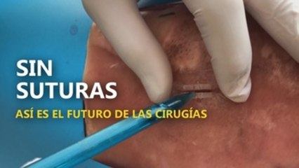 Sin suturas, así es el futuro de las cirugías