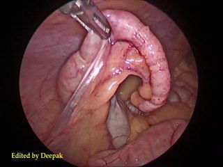 Laparoscopic Appendisectomy | Appendicitis| Appendisectomy