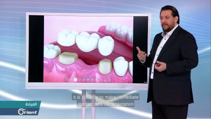 كيف تتم عملية زراعة الأسنان؟ - العايدة