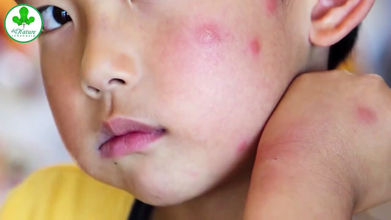 Obat Eskim Basah Dan Kering Ampuh De Nature