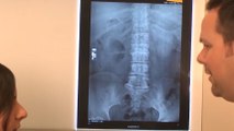 bd-fracturas-vertebrales-por-osteoporosis-240220