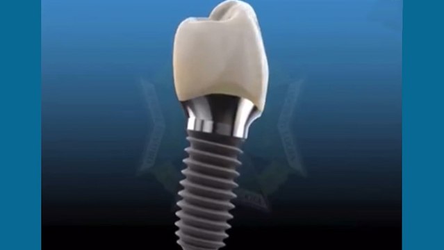 bd-implantes-dentales-240220