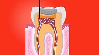 Tooth root canal dental' Dental surgery' Tooth-teeth-dentist_-_dental surgery in Hindi Urdu, dental surgery meaning,