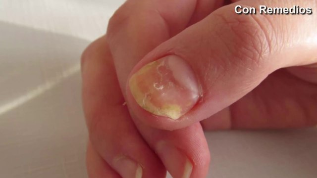 Elimina tus HONGOS con este poderoso REMEDIO CASERO.