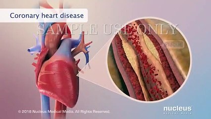 Diabetes and Heart Disease