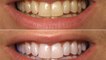 दांतों का पीलापन हटाएगा ये जादुई उपाय ।  Ways to Naturally Whiten Your Teeth at Home । Boldsky