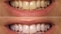 दांतों का पीलापन हटाएगा ये जादुई उपाय ।  Ways to Naturally Whiten Your Teeth at Home । Boldsky