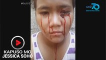 Kapuso Mo, Jessica Soho: 18-anyos na dalaga sa Palawan, lumuluha ng dugo?
