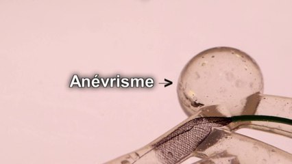 Santé - Un « baby stent » pour prévenir l'AVC
